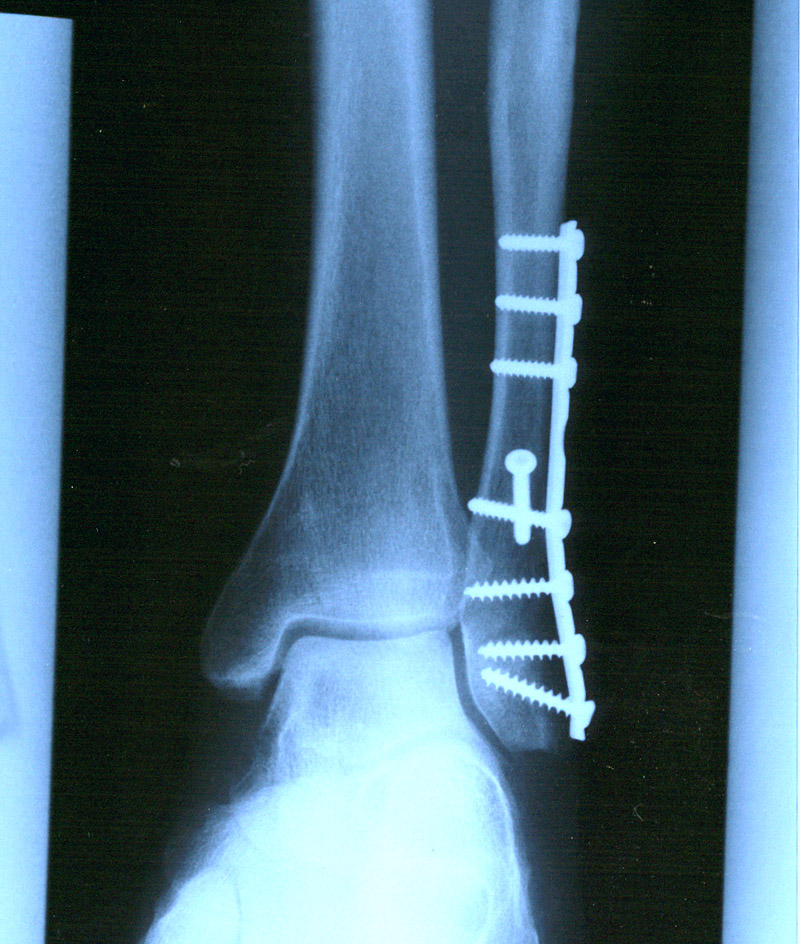 fibula122606.jpg